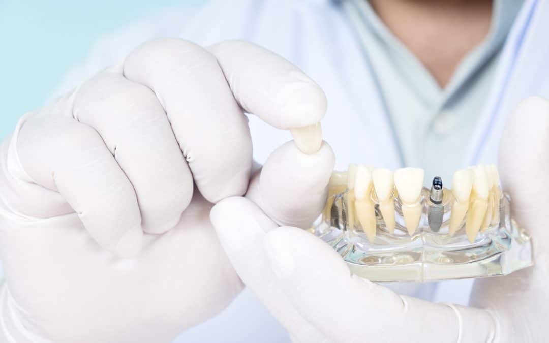 Why Are More People Getting Dental Implants?
