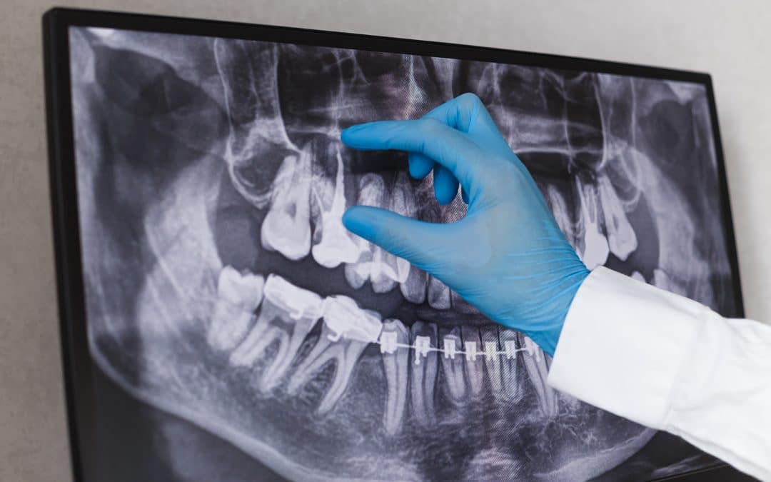 What to Expect During a Root Canal Treatment?